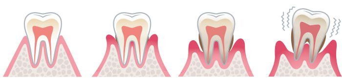 歯周病の進行過程
